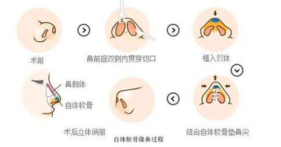 最新隆鼻技術解析，探索美容領域未來趨勢