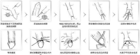 前沿包皮手術技術探索，最新方法與優勢解析